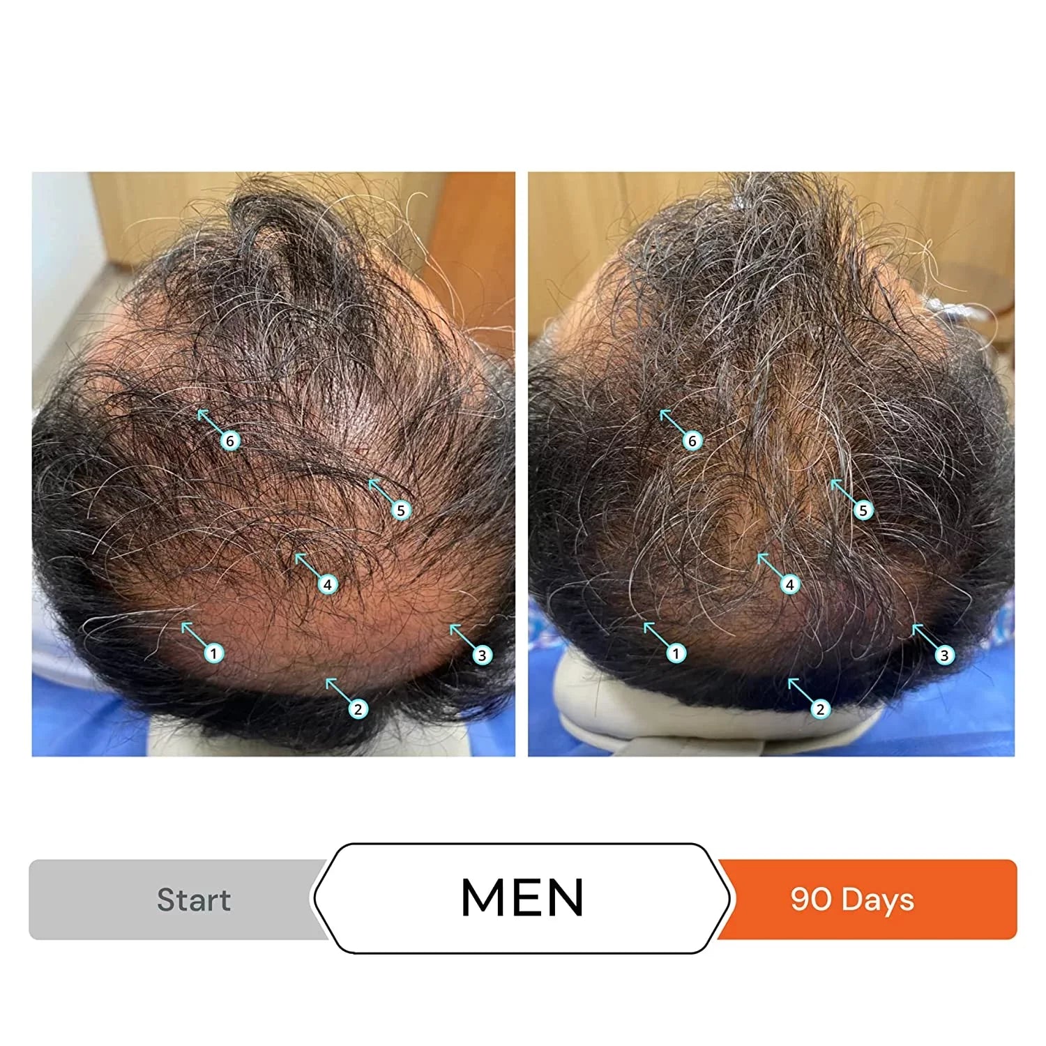 Revita Shampoo w/Biotin, Caffeine and Hair Growth Stimulating Ingredients, Helps Block  w/-N Nanoxidil 5% Hair Regrowth Treatment