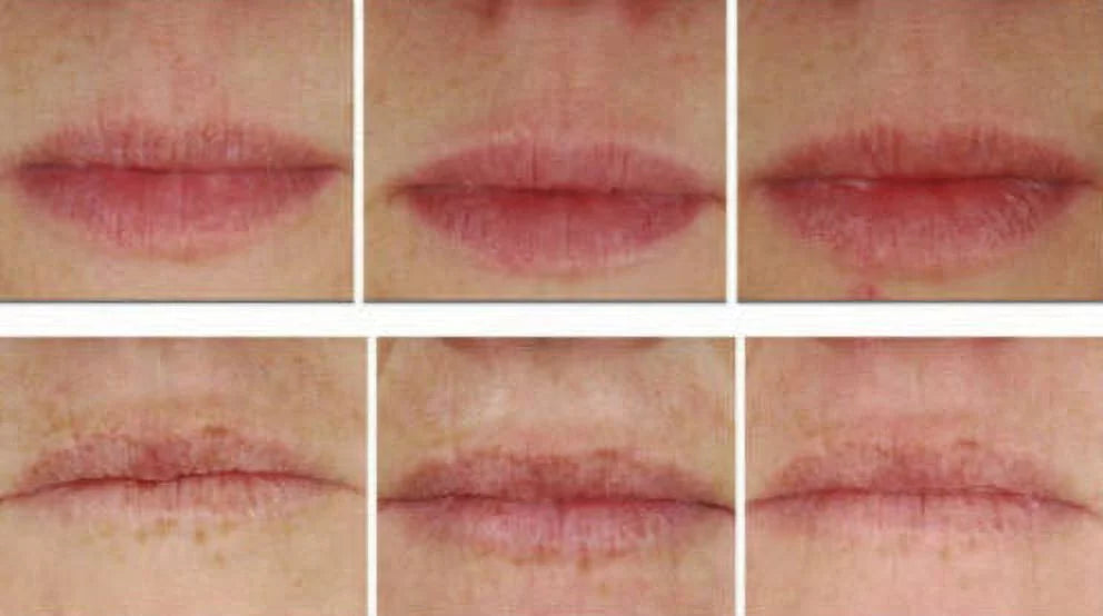 Bellahut Triple Smoothing Upper Lip Cream, .5 oz, with Decorinyl, Tri-Peptide-1 & Matrixyl 3000