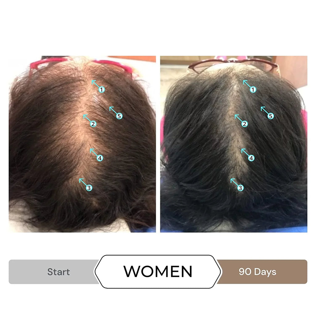 Revita Shampoo w/Biotin, Caffeine and Hair Growth Stimulating Ingredients, Helps Block  w/-N Nanoxidil 5% Hair Regrowth Treatment
