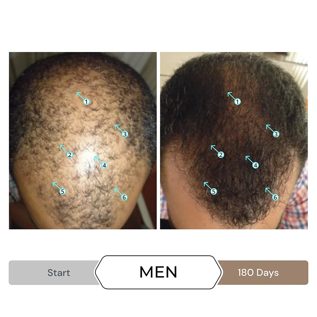 Revita Shampoo w/Biotin, Caffeine and Hair Growth Stimulating Ingredients, Helps Block  w/-N Nanoxidil 5% Hair Regrowth Treatment